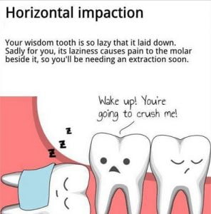 Impacted-Wisdom-Teeth-dental-clinic