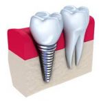 implant-dentar