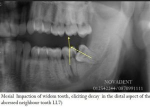 wisdom-tooth-extraction