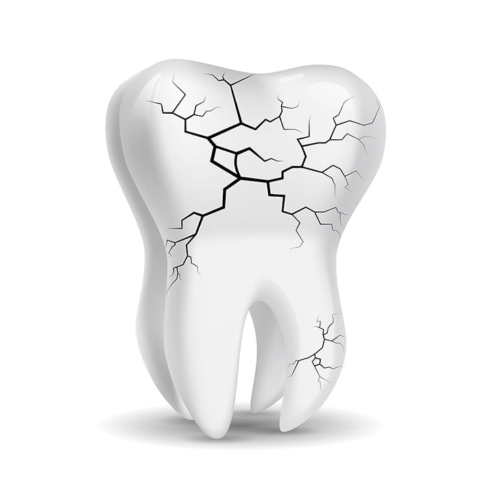 broken-tooth-dublin