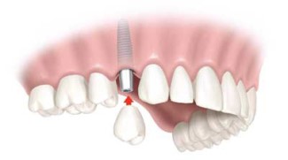 dental_implant_closeup_dentist